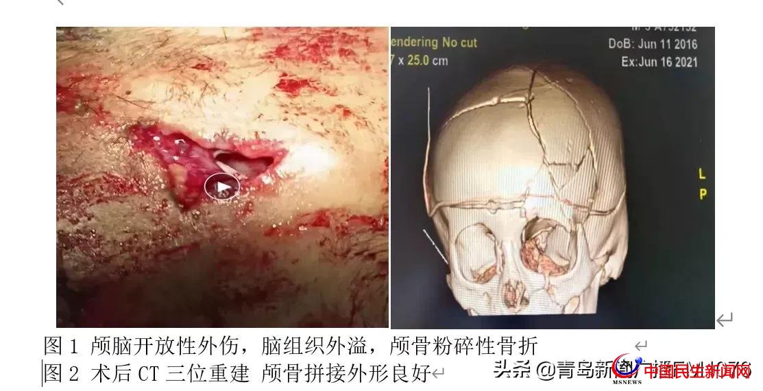 5歲男童6樓墜落命懸一線，婦兒醫(yī)院多學(xué)科協(xié)作再勝“死神”